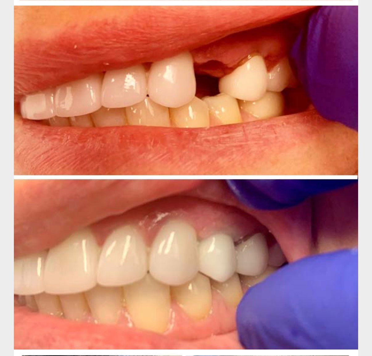 Smile Transformation Case 1
