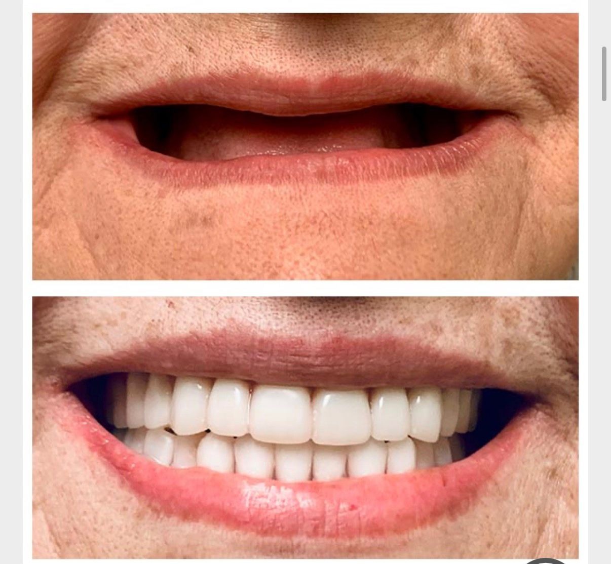 Smile Transformation Case 2