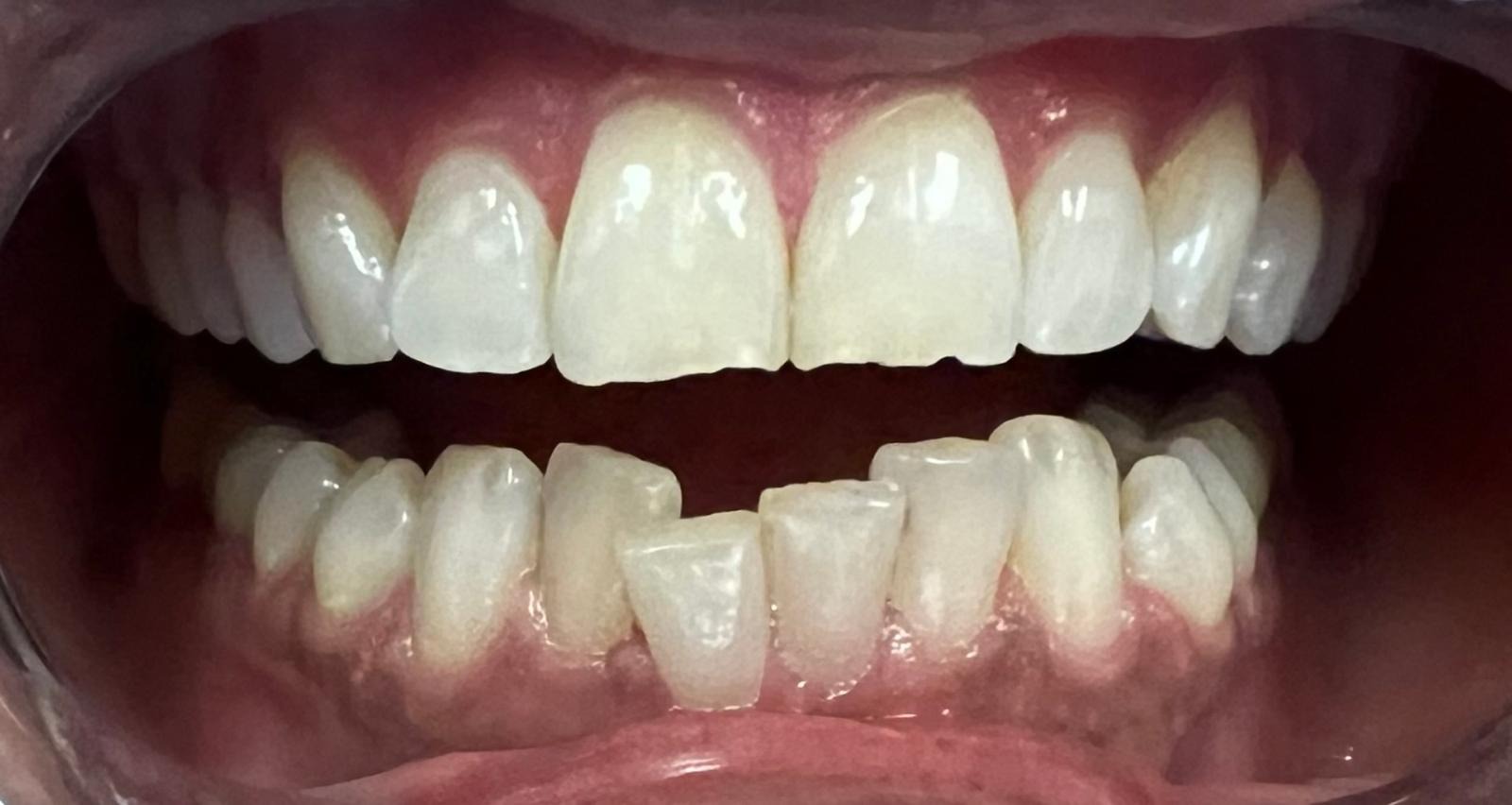 Before Aligner Treatment