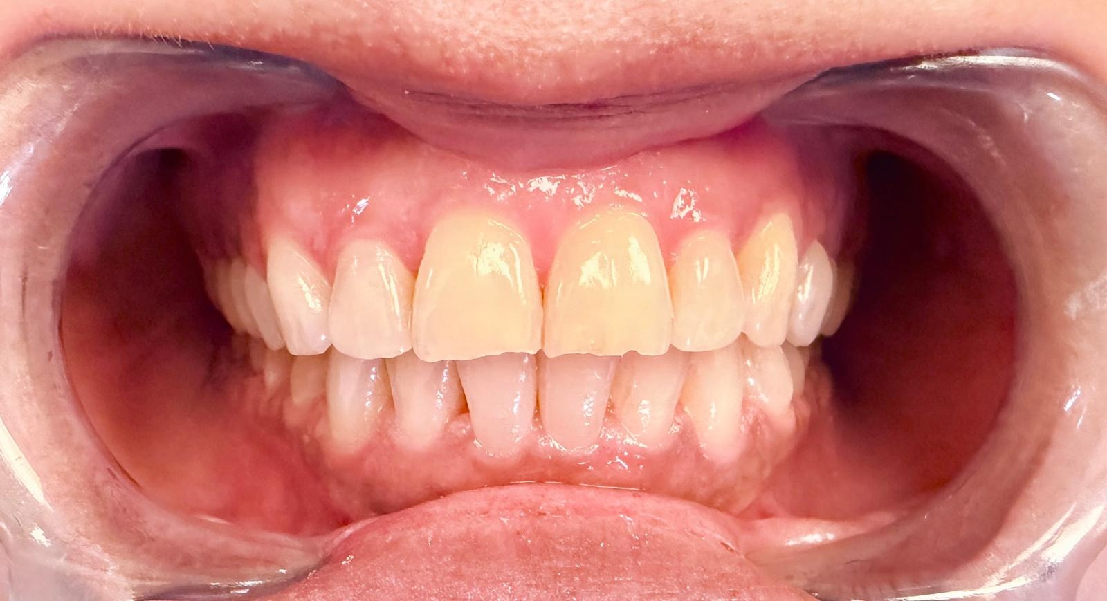 After Aligner Treatment