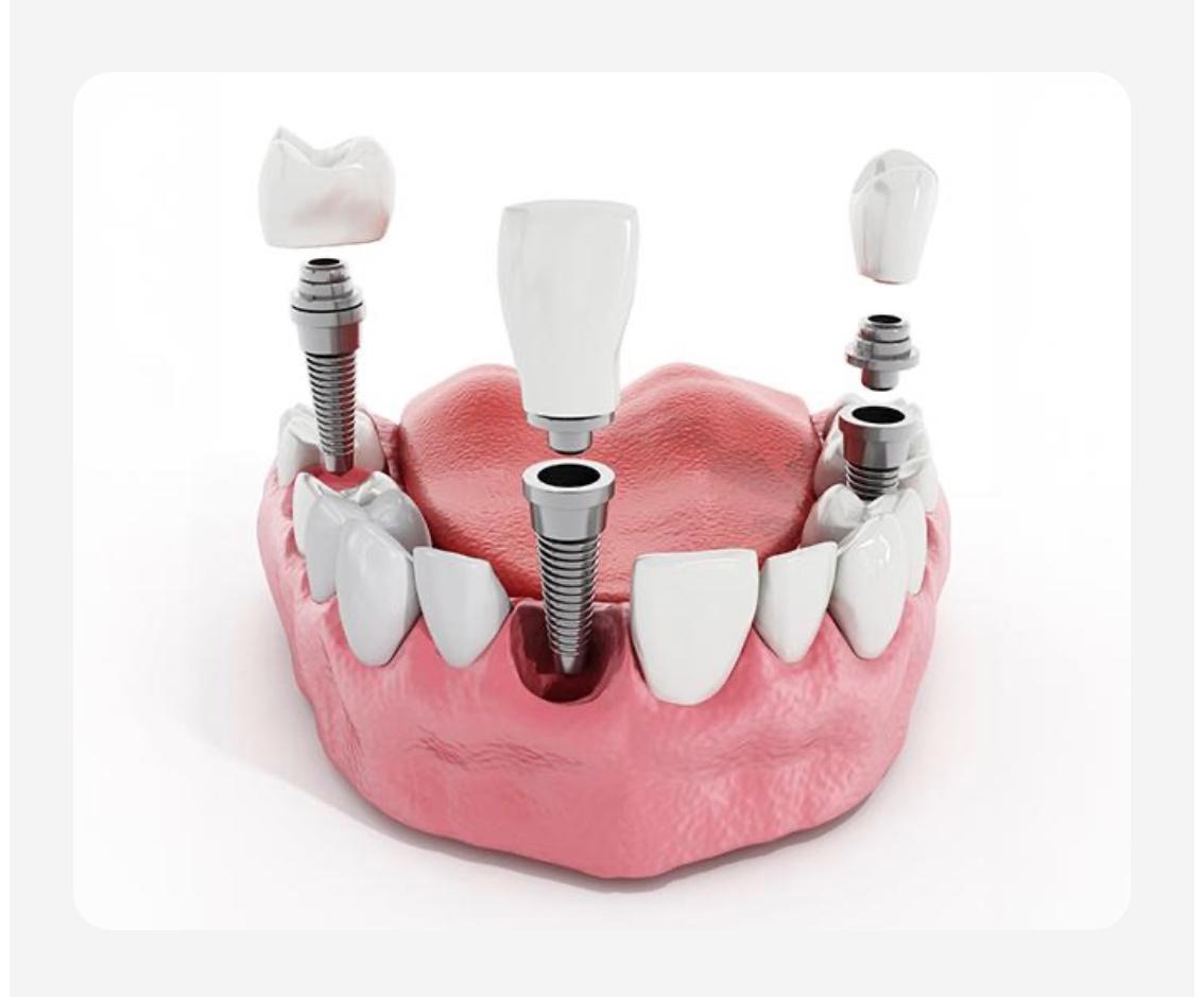 Natural SmileOn Implant Patient